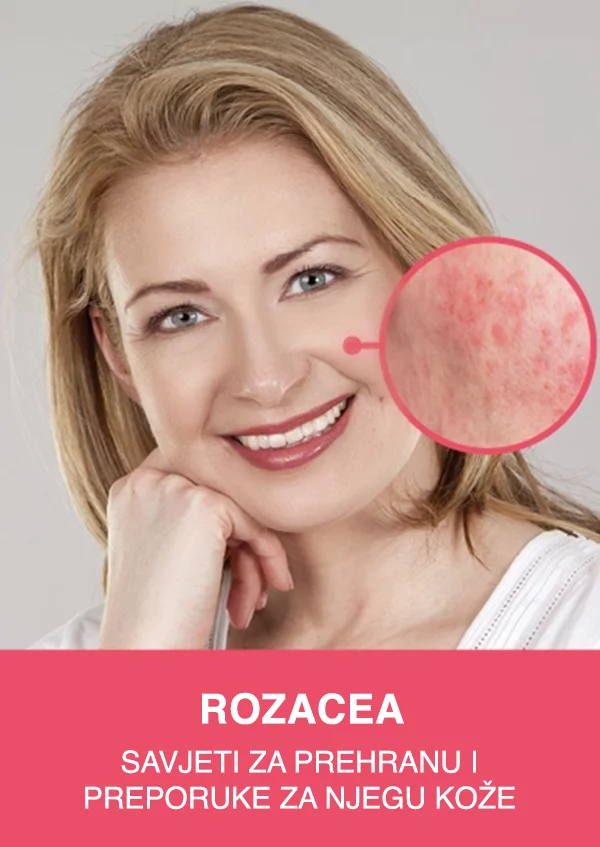 Rozacea
